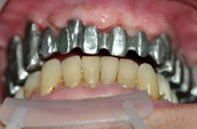 Elmhurst Dental Implants