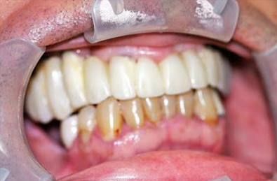Elmhurst NY dental implants