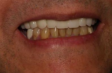 Dental implants Elmhurst NY